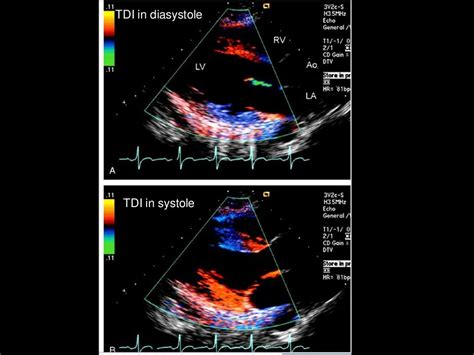 lv san francisco|echocardiography lv function.